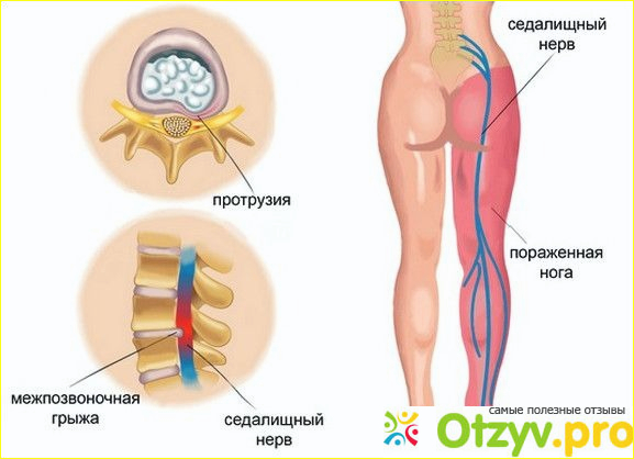 Отзыв о Воспаление, защемление седалищного нерва: симптомы, лечение