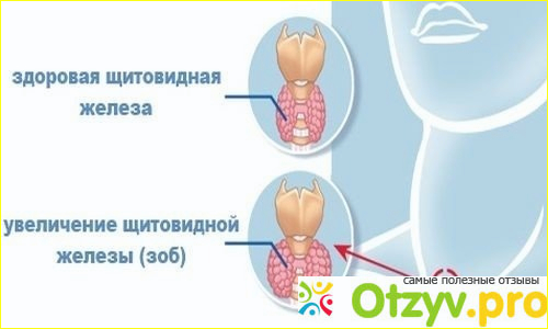 5. Выброс содержимого желудка в пищевод. 