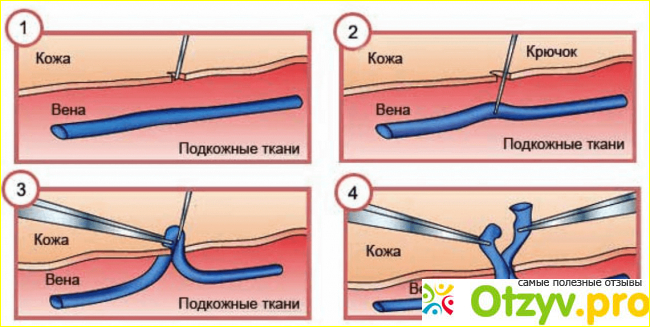 Отзыв о Операция Флебэктомия