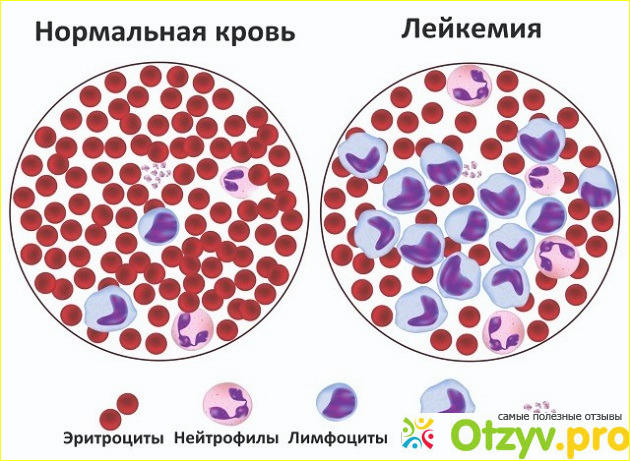 Что происходит, когда у вас повышенные лейкоциты?