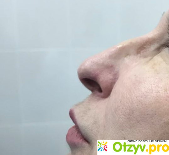 Отзыв о Бузаперационная ринопластика филлерами Revanesse