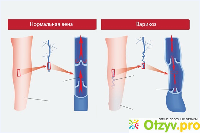 Отзыв о Варикоз на ногах: лечение. Как лечить варикоз вен на ногах