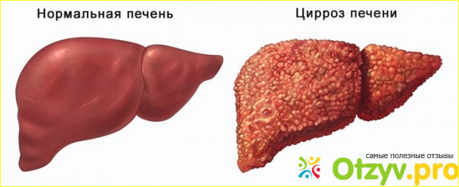 Отзыв о Цирроз печени: симптомы, признаки, лечение