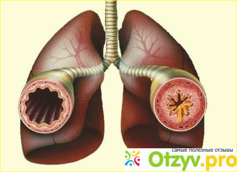 Отзыв о Острый бронхит: симптомы, лечение острого обструктивного бронхита