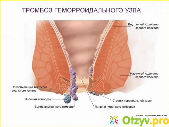 Кровотечение из заднего прохода у женщин