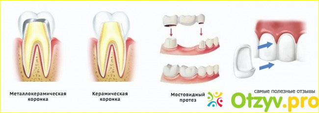 Протезирование зубов виды какой протез лучше отзывы фото1