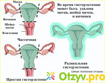 Отзыв о После удаления матки отзывы женщин