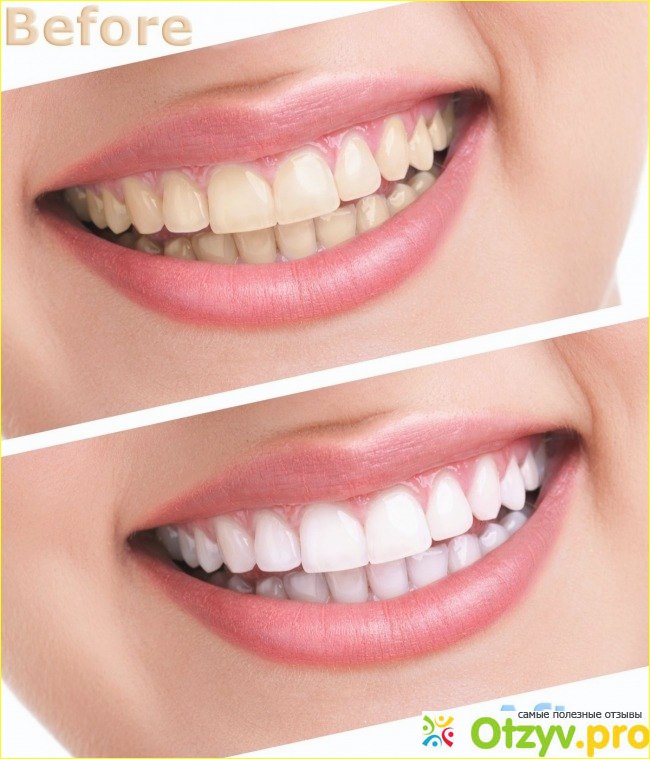 •• 3D White Whitestrips LUXE Professionals Effects, Crest••