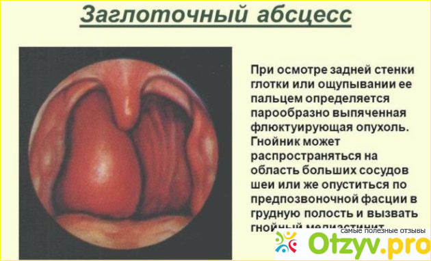 Причины возникновения опухоли горла.