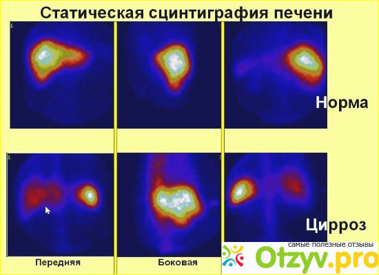 Гемангиома делится на 2 типа