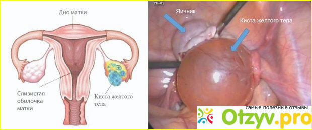 Отзыв о Киста желтого тела яичника