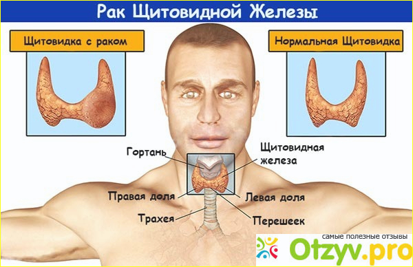 Отзыв о Рак щитовидной железы симптомы