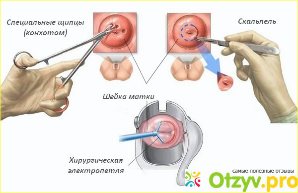 Отзыв о Эрозия шейки матки