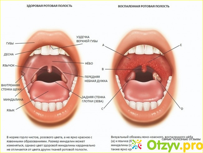 Как вылечить ангину без антибиотиков фото1