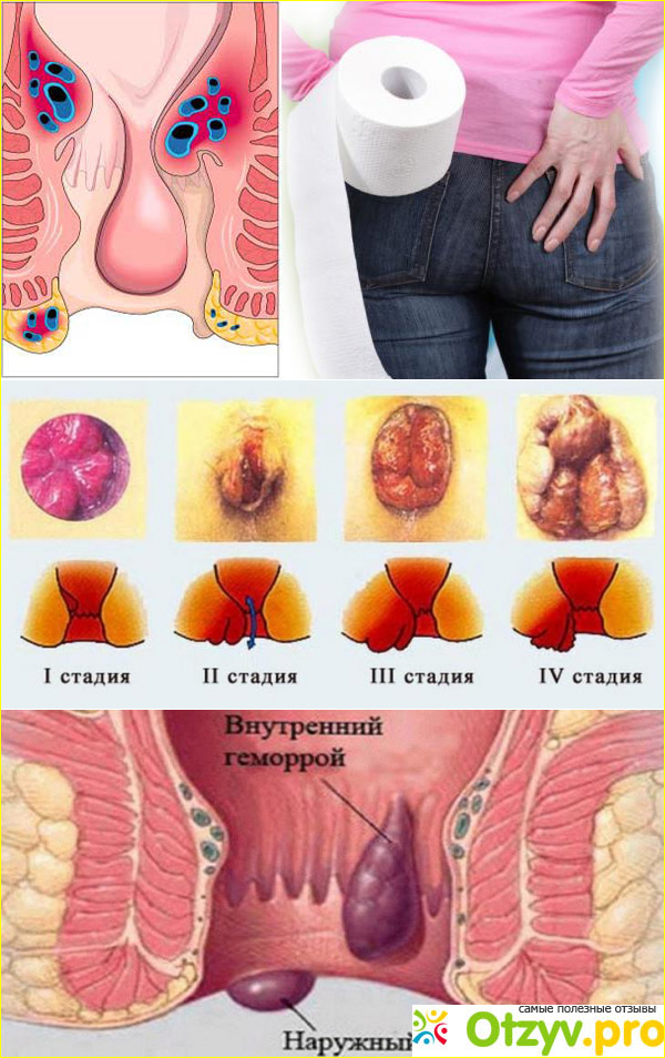 Отзывы свечи от геморроя фото2