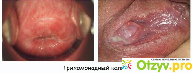 Кольпит при беременности фото1