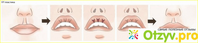Отзывы увеличение губ
