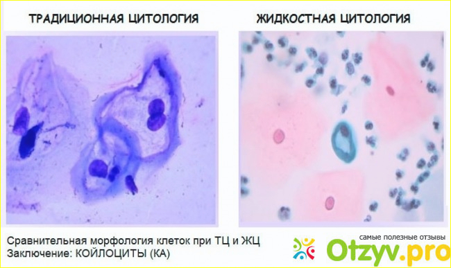 Что следует знать о эрозии шейки матки?