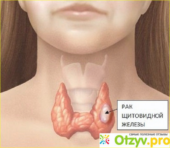 Рак щитовидной железы симптомы фото1