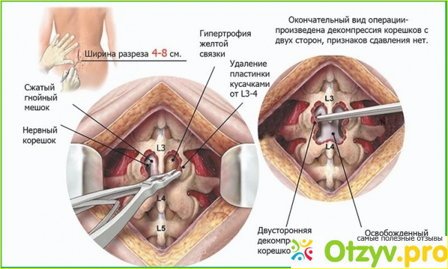 Отзыв о Грыжа позвоночника поясничного отдела лечение