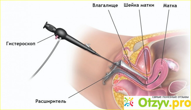 Отзыв о Гистероскопия матки что это