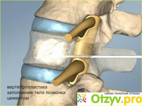 Суть оперативного вмешательства.