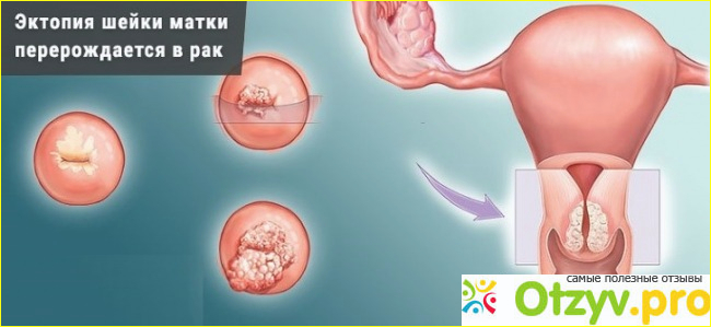 Эктопия шейки матки лечение.