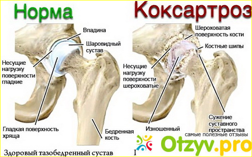 Аналоги мази Ибопрофен