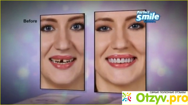 Плюсы Perfect smile veneers