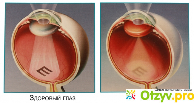 Катаракта операция отзывы какой хрусталик лучше фото1