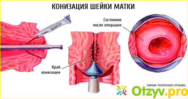 Противопоказания: