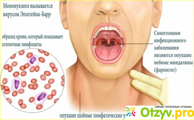 Чем опасен мононуклеоз.