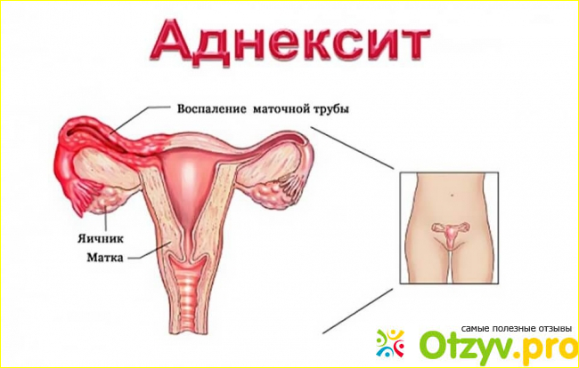 Воспаление яичников. Основные причины.