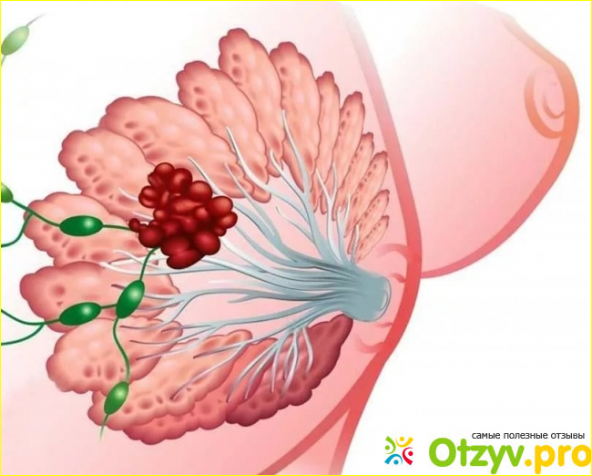Отзыв о Отзывы больных раком молочной железы после пятилетнего лечения ана