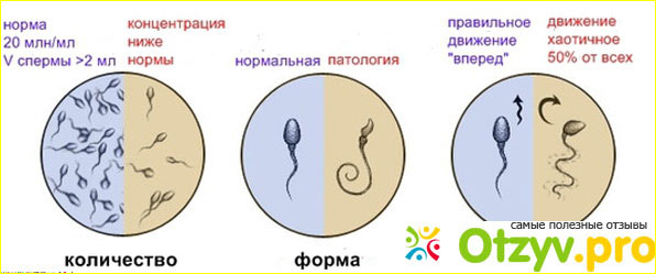 Бесплодие у мужчин: признаки и симптомы, причины фото1