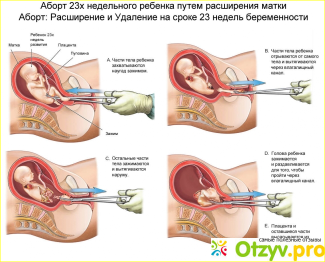 Хирургический аборт отзывы фото2