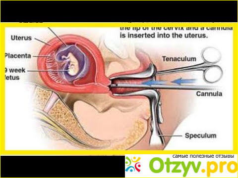 Хирургический аборт отзывы фото1