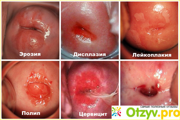 Отзыв о Эрозия шейки матки: причины, симптомы, лечение