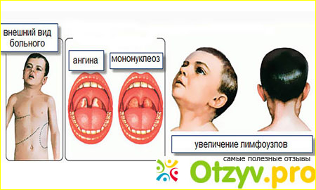 Неспецифичные симптомы.