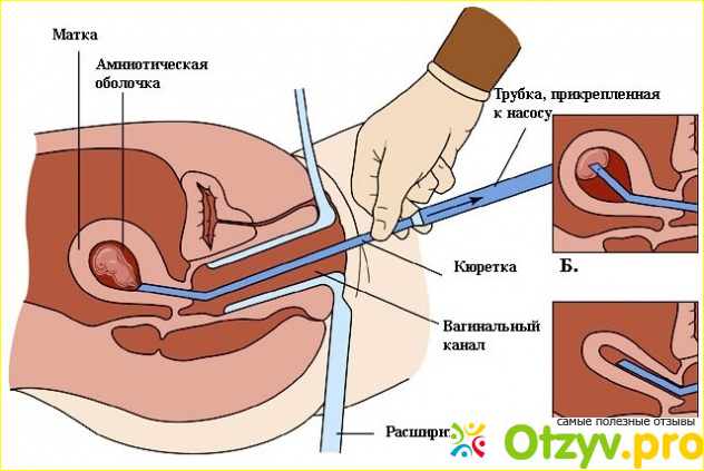 Отзыв о Хирургический аборт отзывы