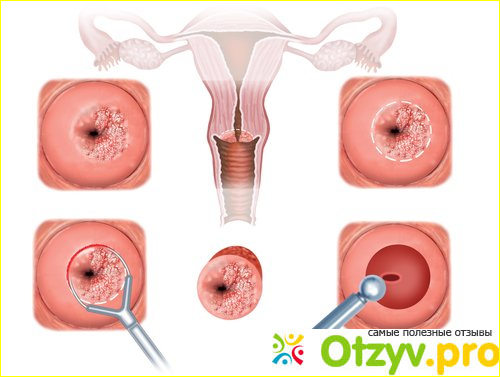 Эрозия шейки матки: причины, симптомы, лечение фото1