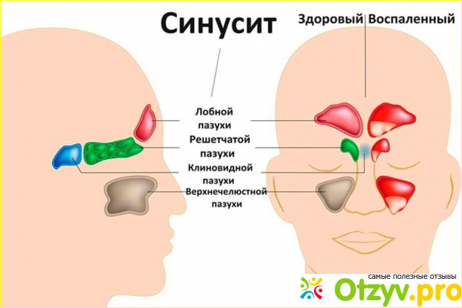 Диагностика фронтита.