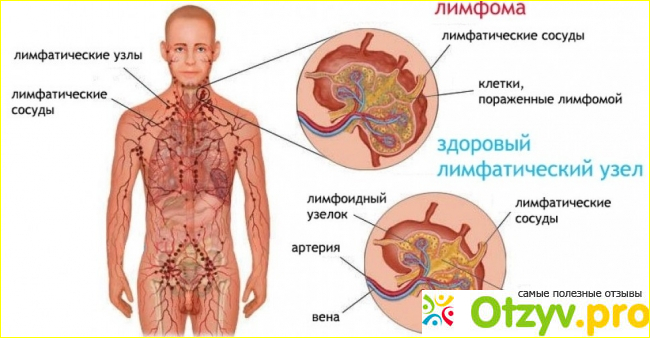 Питание во время лимфомы. 