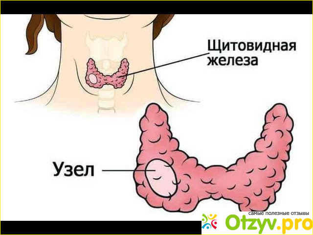 Лечение патологий щитовидной железы?