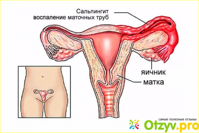 Отзыв о Хронический сальпингит и оофорит