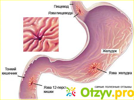 Причины появления язвы?