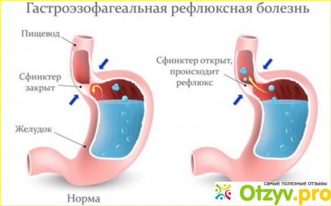 Осложнения 