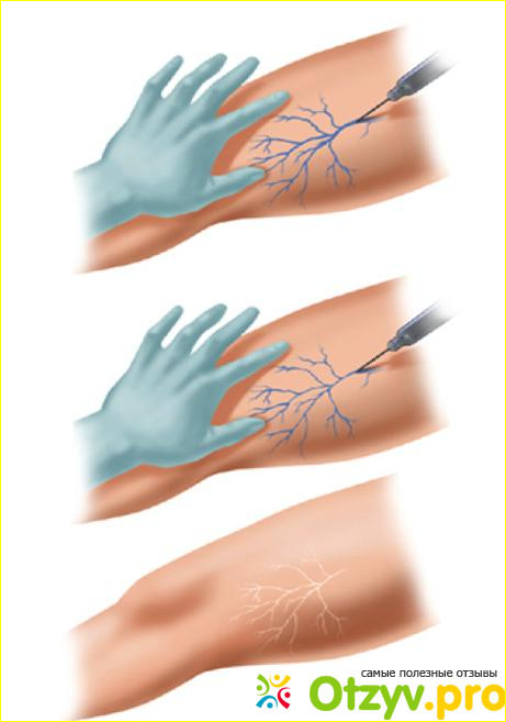 Каким образом происходит процедура склерозирования вен