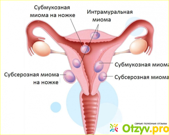 Отзыв о Снятие тонуса матки