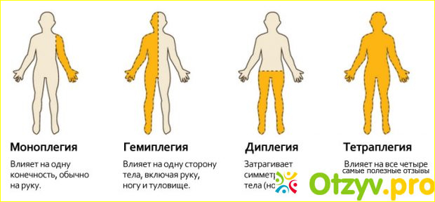 Как выявляют парез и какими симптомами выражается